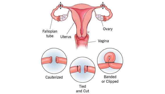 Tubal Recanalization
