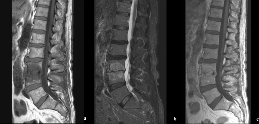 Tuberculosis, pyogenic spondylodiscitis, fungal infections