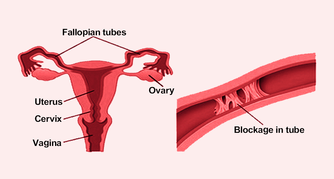 Tuboplasty (For blocked fallopian tubes)