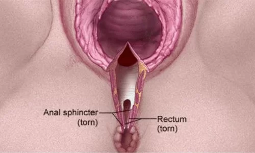 Vaginal