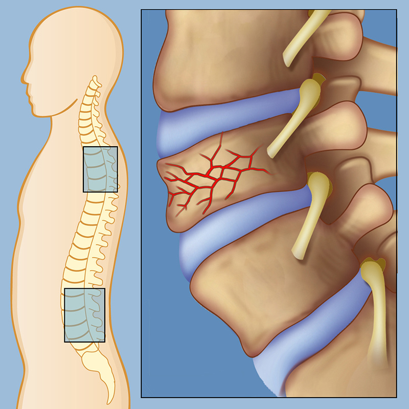 Vertebral fractures, spinal cord injuries