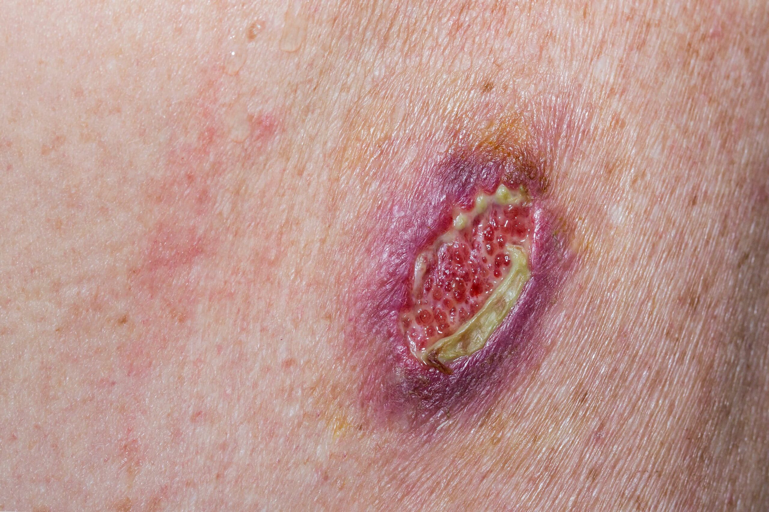 Wound debridement and closure (post-trauma)