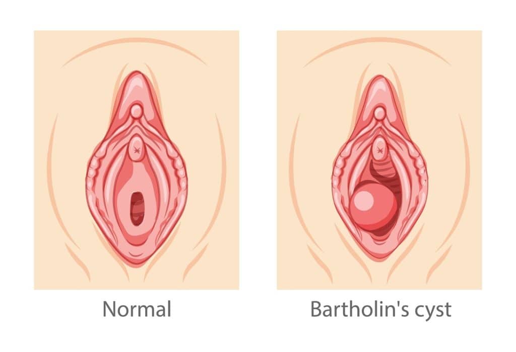 bartholin cyst excision