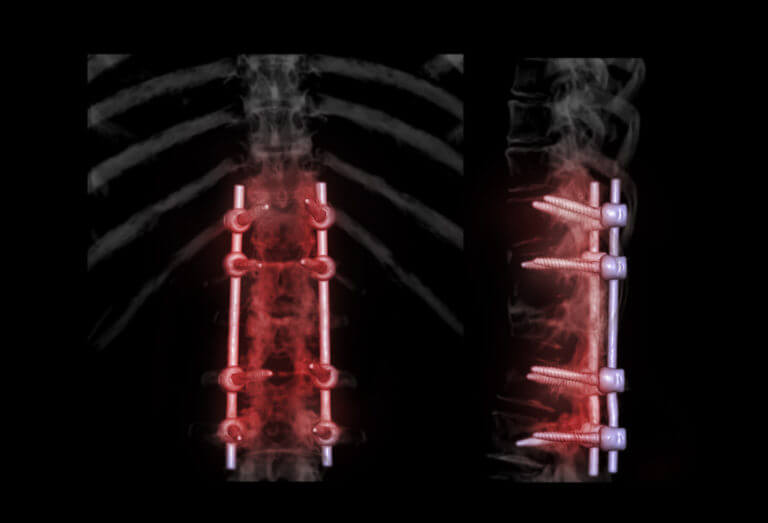 degenerative spine surgery