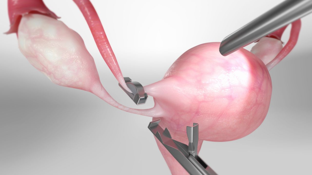 laparoscopic tubal ligation