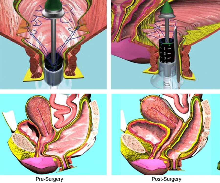 surgery for rectal prolapse